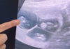 Пациентка на 58 години останала бремена со тројкa, објави д-р Таше Трпчевски